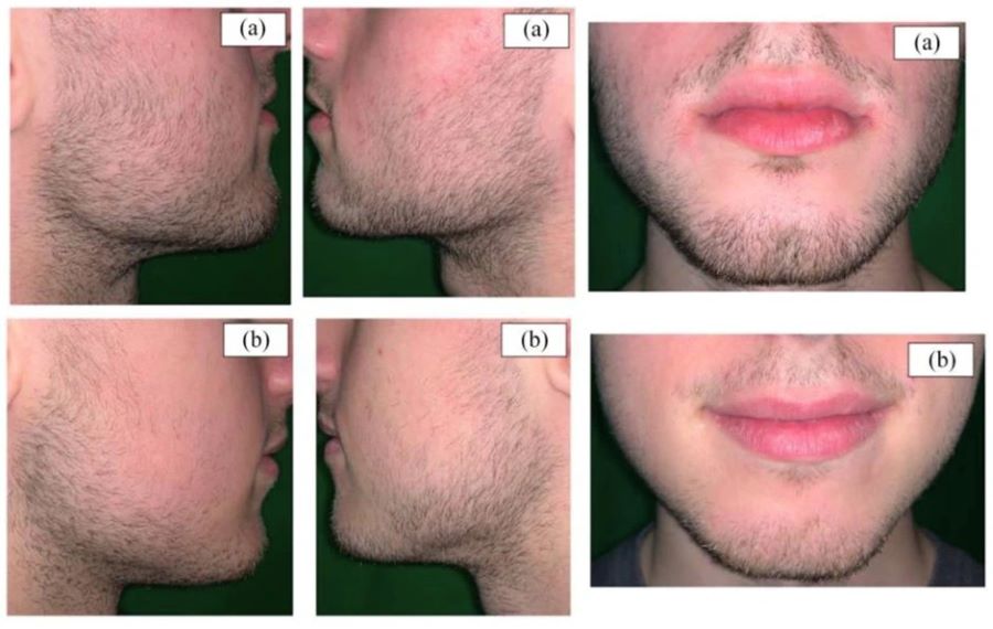 Twins showing the effects of using Minoxidil for beard growth