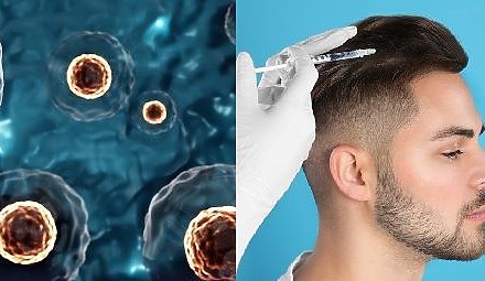 What Does Stem Cell Hair Treatment Cost And Is It Worth It?