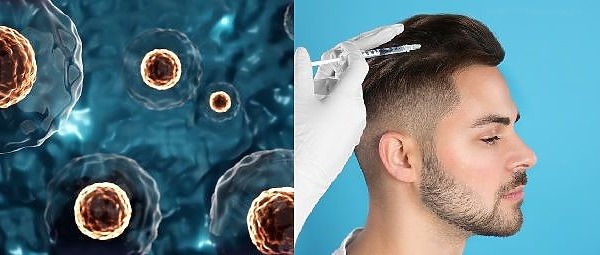 What Does Stem Cell Hair Treatment Cost And Is It Worth It?