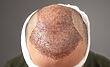 Hair Transplant