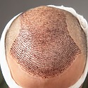 Advanced Hair Restoration Cost: How Much Should You Pay?