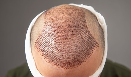 Advanced Hair Restoration Cost