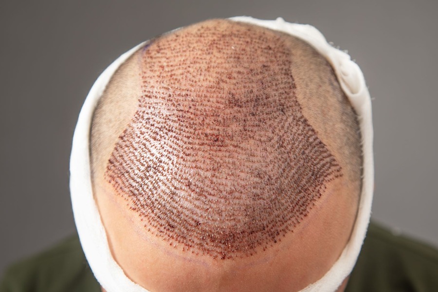 Advanced Hair Restoration Cost