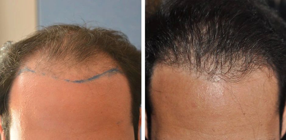 before and after FUT hair transplant