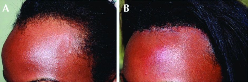 before and after forehead reduction