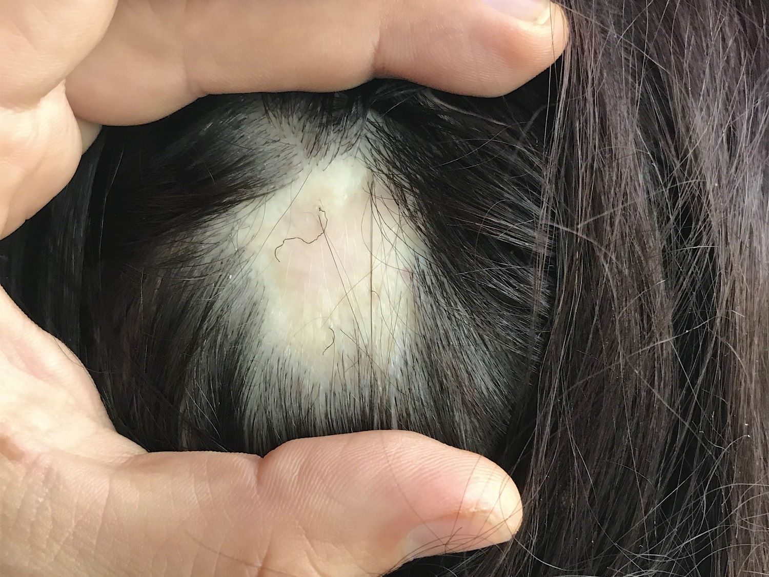 dead hair follicles from a scar on the scalp