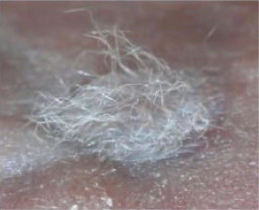 stem cell hair transplant performed on mouse