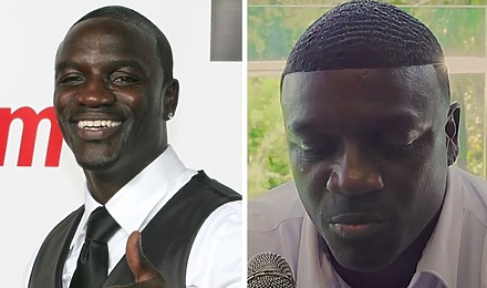 Akon Hair Transplant