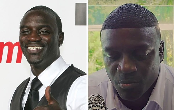 Akon hair transplant