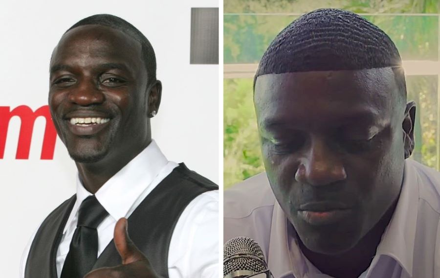 Akon before and after his hairline lowering transplant