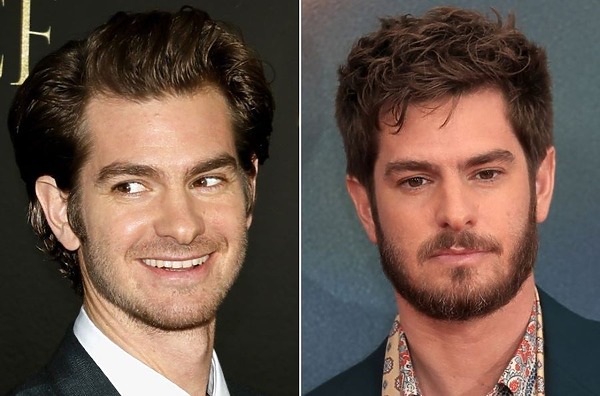 Andrew Garfield hair transplant