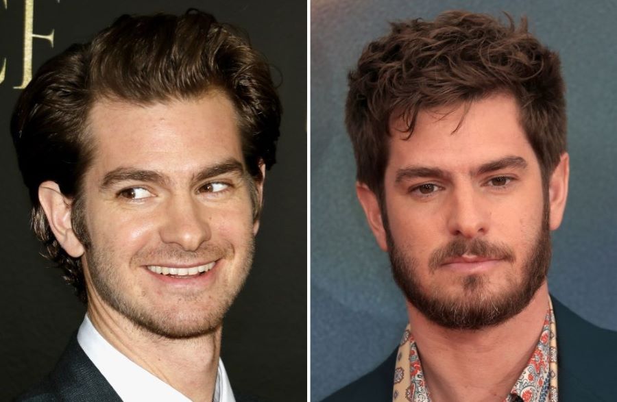 Andrew Garfield’s hair transplant before and after