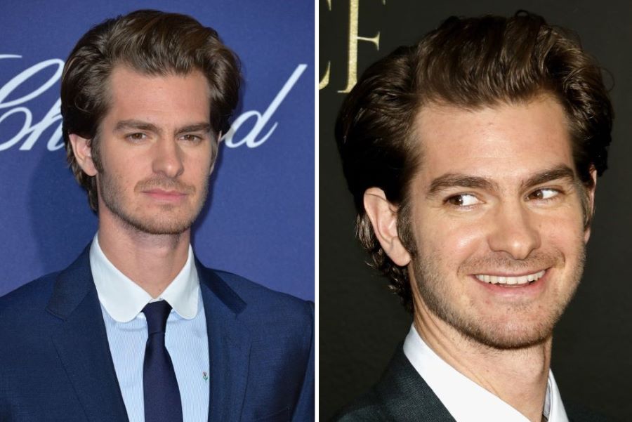 Andrew Garfield’s temple hair loss