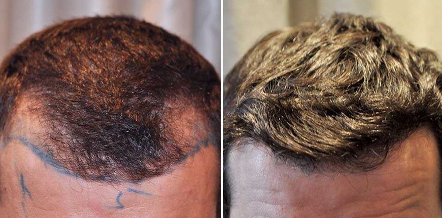 Before and after hair transplant from the Wimpole Clinic