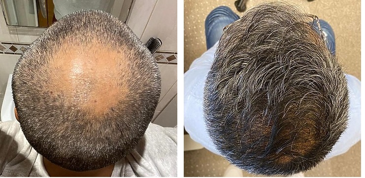 Man before and after hair transplant at the Wimpole Clinic