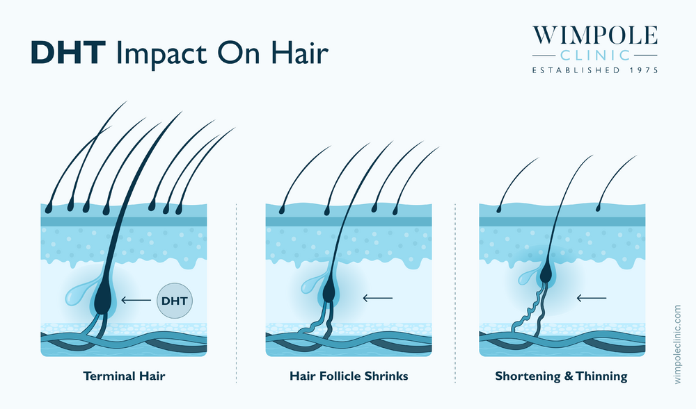 Impact of DHT on hair growth