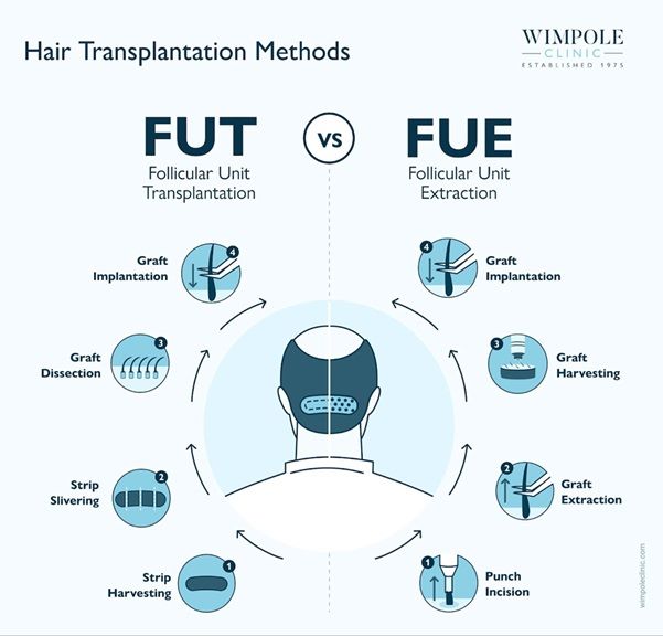 FUT vs FUE hair transplant