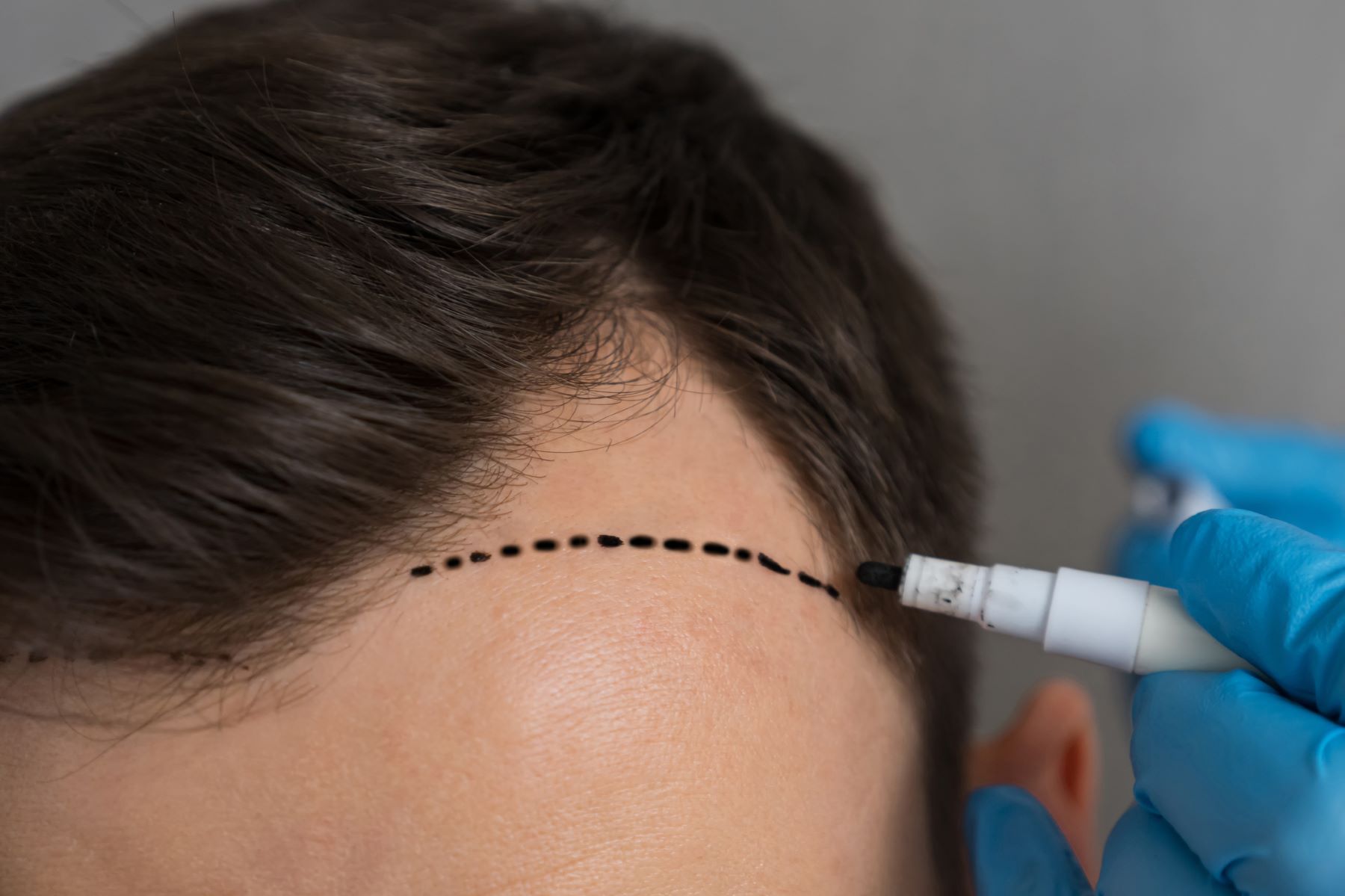 Hair transplant for men