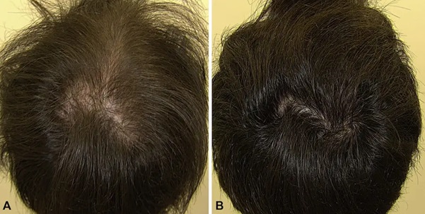 Male patient before and after Minoxidil treatment