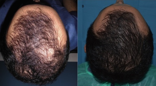 Male patient before and after PRP hair treatment