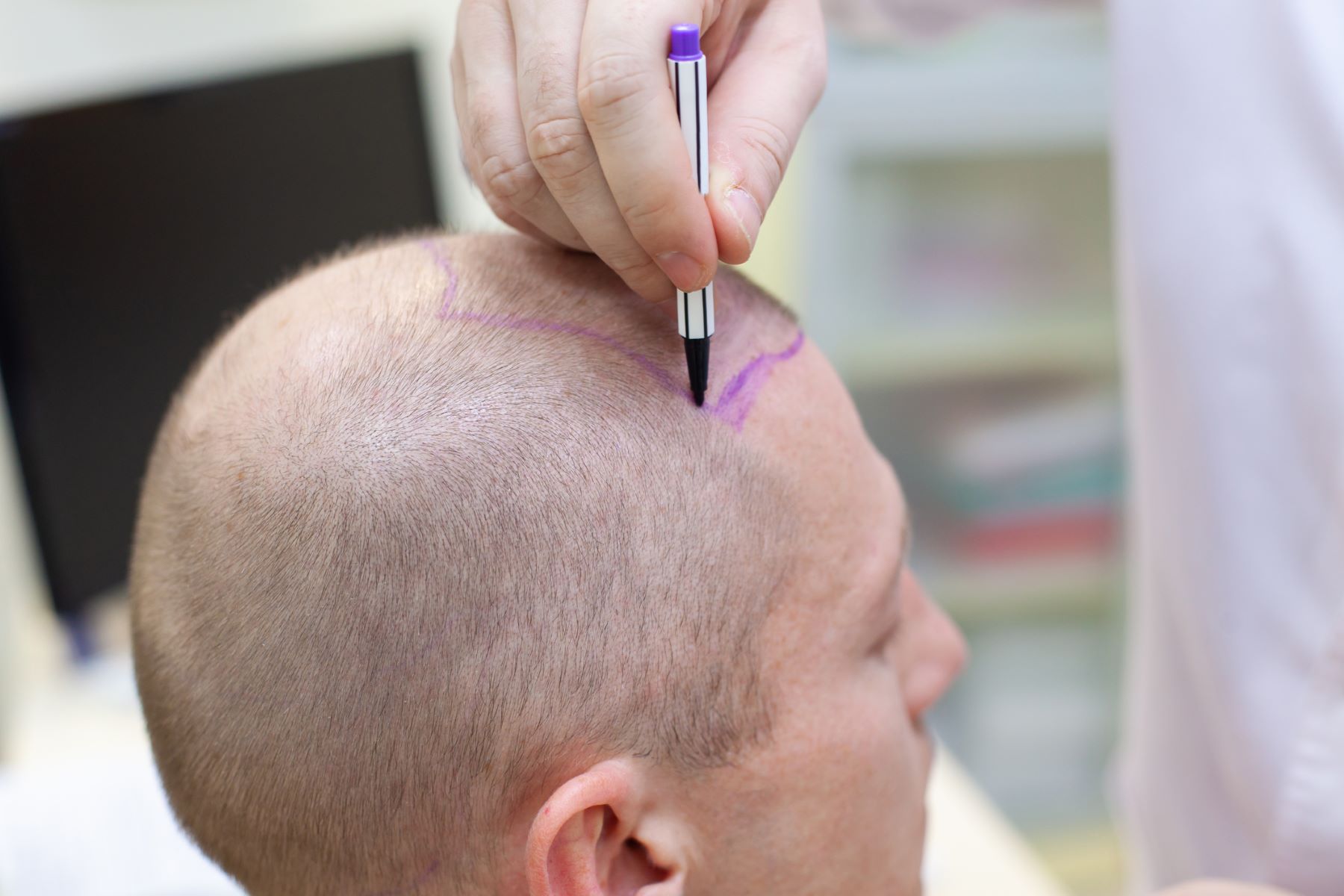 Male patient being prepared for his hair transplant