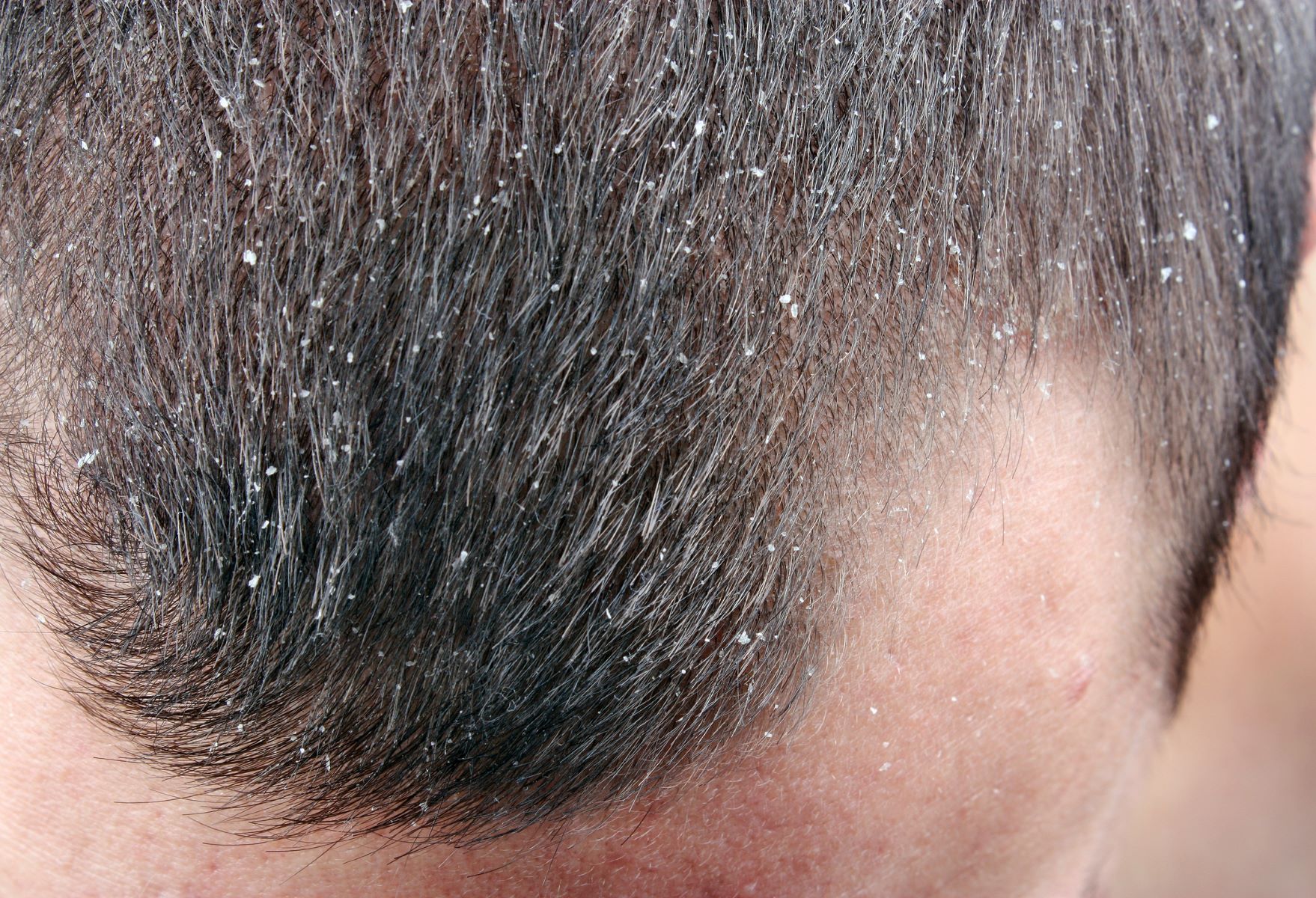 Man experiencing dandruff