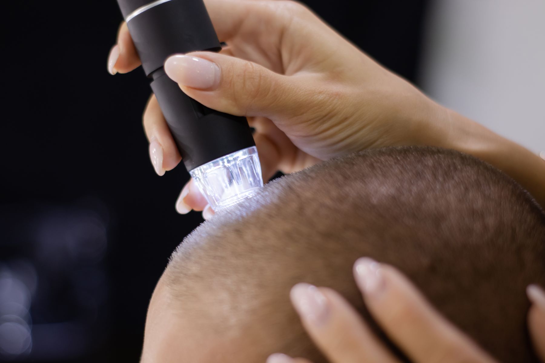 Man getting his hair miniaturisation diagnosed