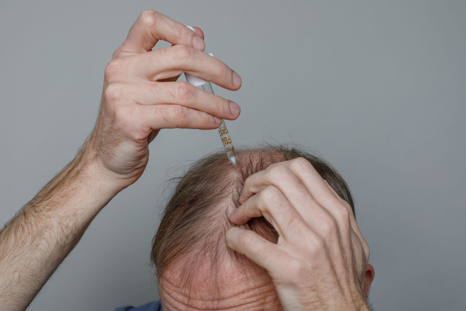 Man using treatment to reverse hair miniaturisation