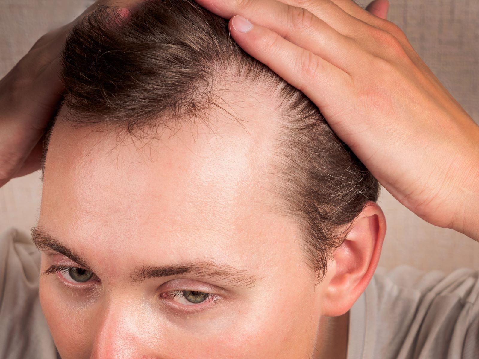 Man with androgenetic alopecia