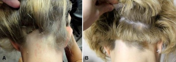 PRP for hair results on ophiasis alopecia areata