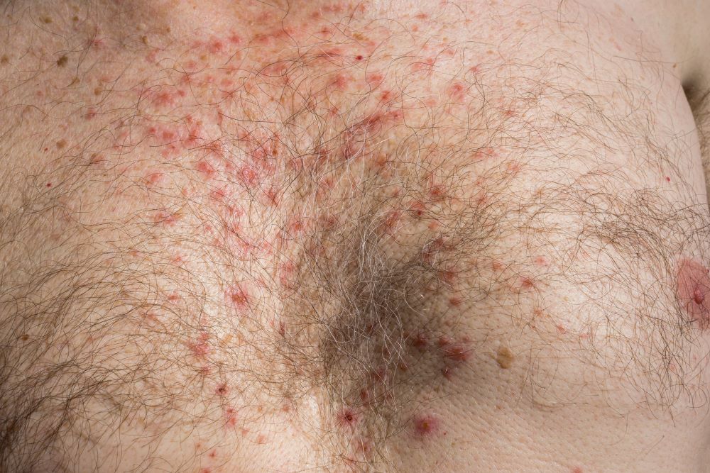 Rash from a drug reaction