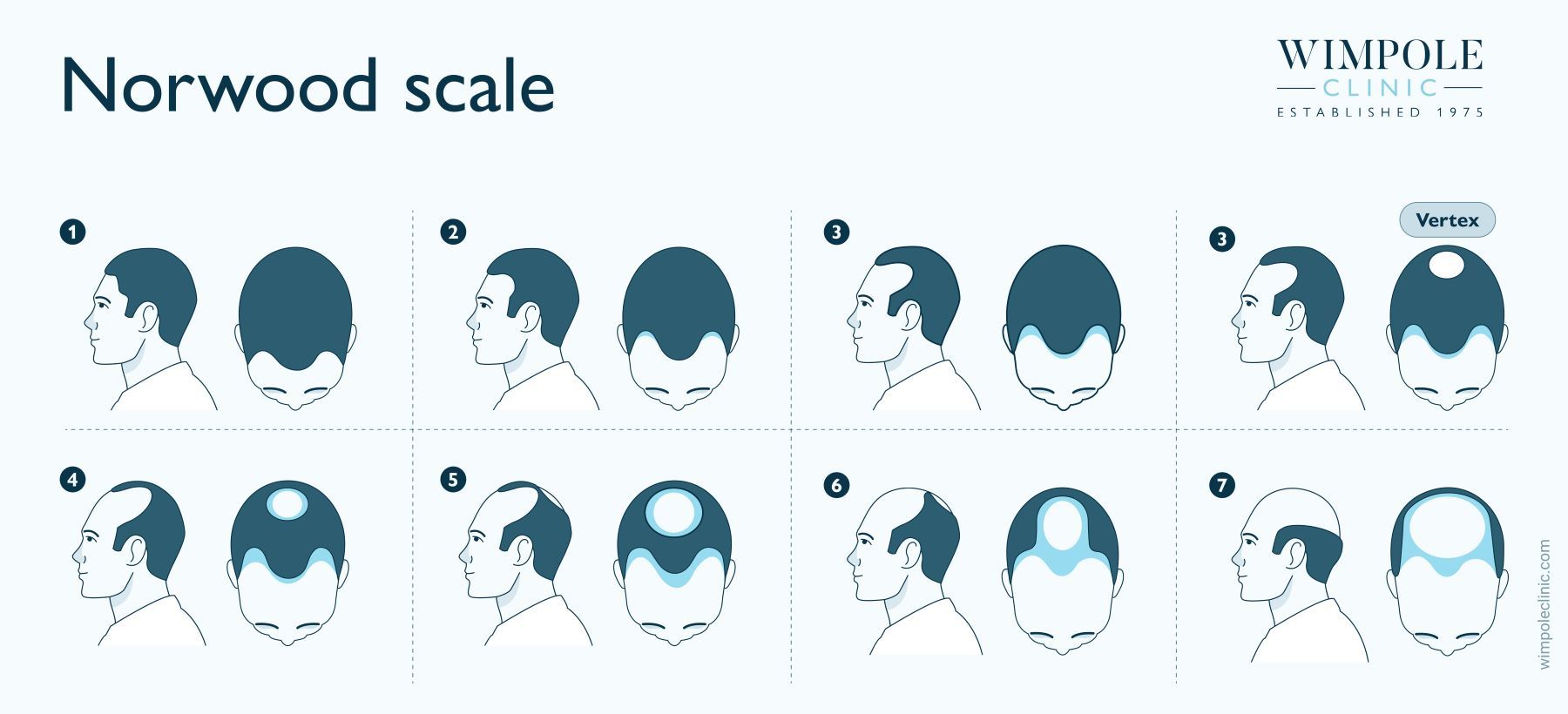 The Norwood Scale for male pattern baldness