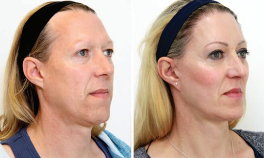 Trans woman before and after hair transplant