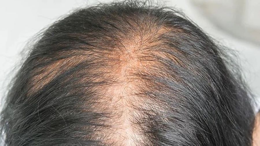 Woman with female pattern baldness