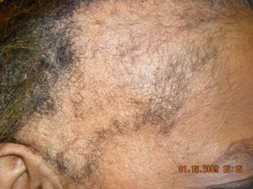 Woman with traction alopecia