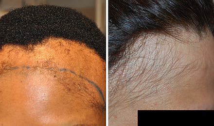 Frontal Fibrosing Alopecia