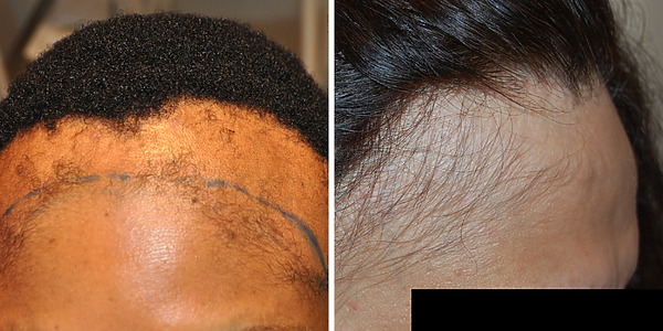 frontal fibrosing alopecia