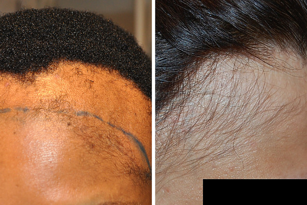 Frontal Fibrosing Alopecia