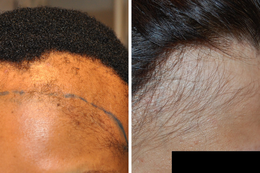 Frontal Fibrosing Alopecia