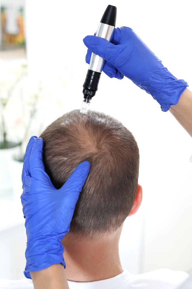 hair mesotherapy for hair loss