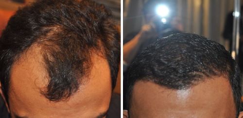 hair transplant before and after