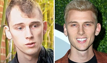 Machine Gun Kelly Hair Transplant