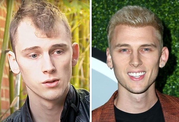 machine gun kelly hair transplant