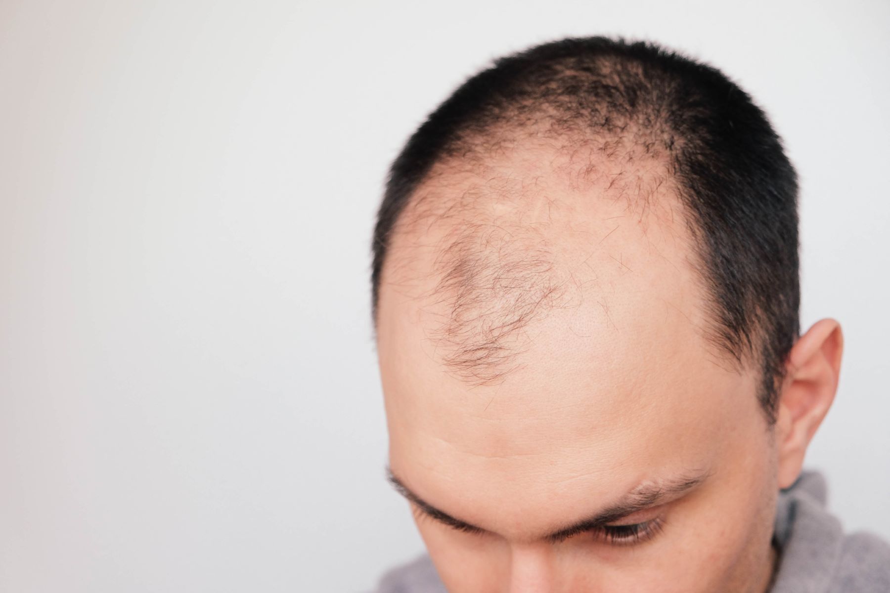 male pattern baldness