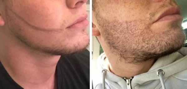 2500 graft beard transplant