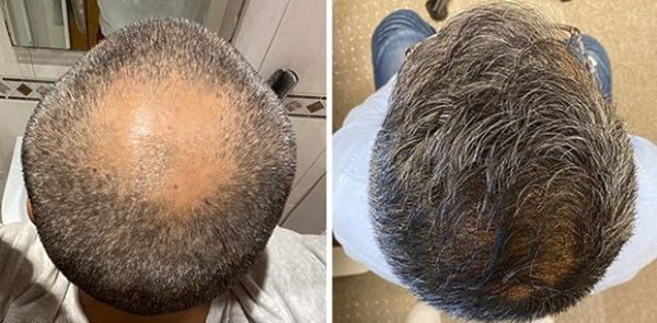 2500 graft hair transplant for androgenetic alopecia