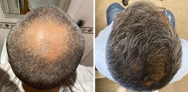 Wimpole patient before and after 2500 graft hair transplant