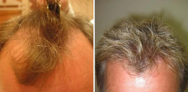 Wimpole patient before and after 2500 graft hair transplant