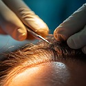 2500 Graft Hair Transplant: Coverage, Costs, Results