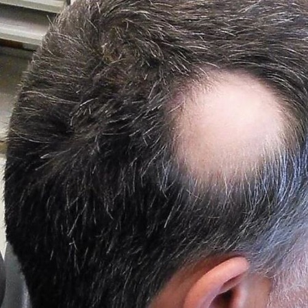 Alopecia areata